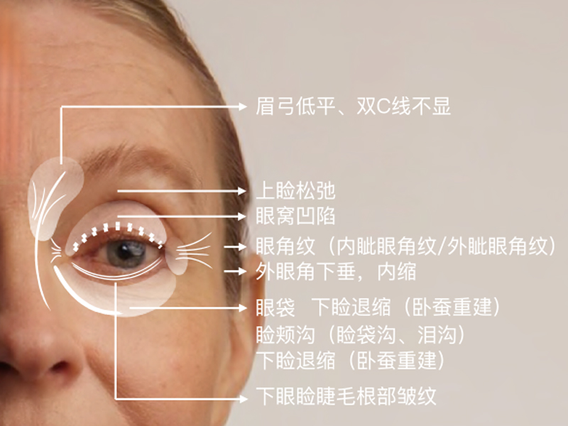针美汇祛除眼袋