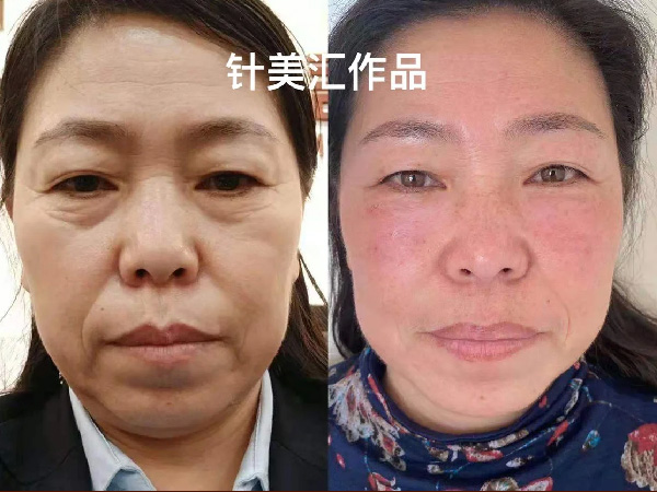 针美汇眼部非手术袪眼袋