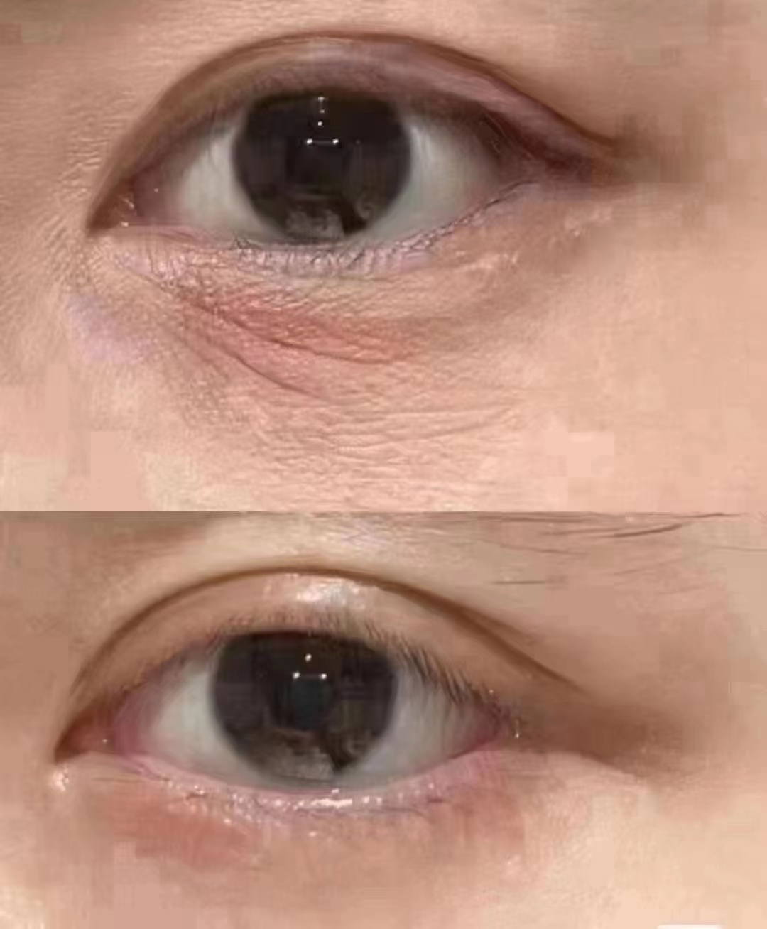 针美汇眼部非手术袪眼袋