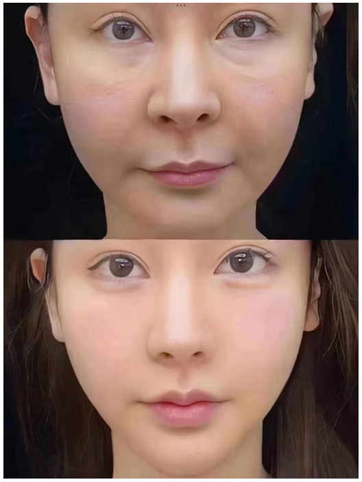 妈生脸针孔微拉技术案例